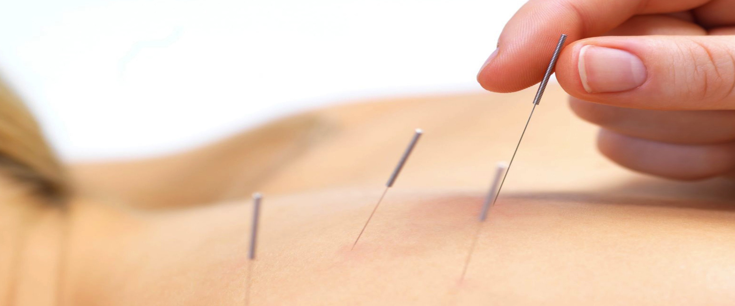 acupuncture-back-on-track-physio
